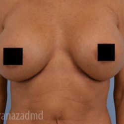 Breast Augmentation Before & After Patient #2138