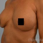Breast Augmentation Before & After Patient #2138