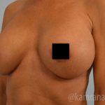 Breast Augmentation Before & After Patient #2138