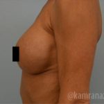 Breast Augmentation Before & After Patient #2138