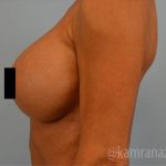 Breast Augmentation Before & After Patient #2138
