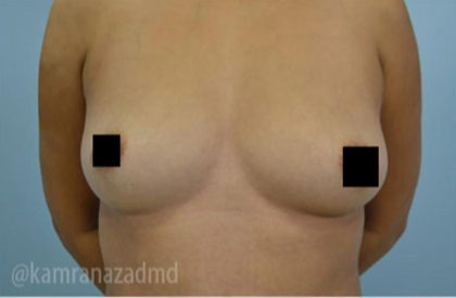 Breast Augmentation Before & After Patient #2139