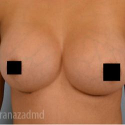Breast Augmentation Before & After Patient #2139