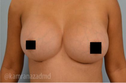 Breast Augmentation Before & After Patient #2139