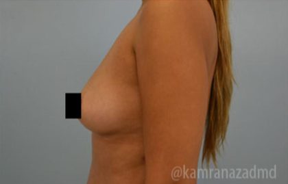 Breast Augmentation Before & After Patient #2139