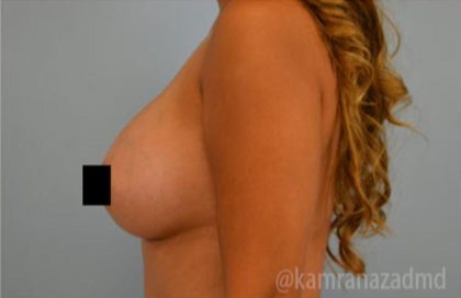Breast Augmentation Before & After Patient #2139