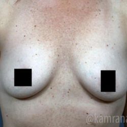 Breast Augmentation Before & After Patient #2140