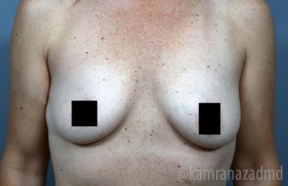 Breast Augmentation Before & After Patient #2140