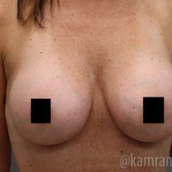 Breast Augmentation Before & After Patient #2140