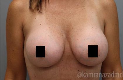 Breast Augmentation Before & After Patient #2140