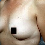 Breast Augmentation Before & After Patient #2140