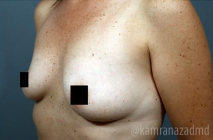 Breast Augmentation Before & After Patient #2140