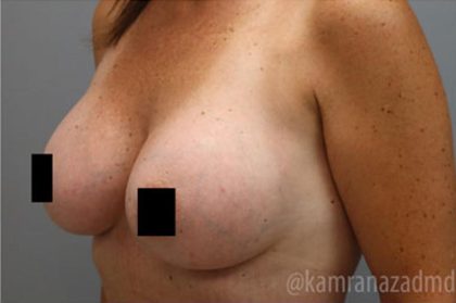 Breast Augmentation Before & After Patient #2140