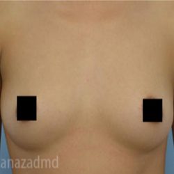 Breast Augmentation Before & After Patient #2141