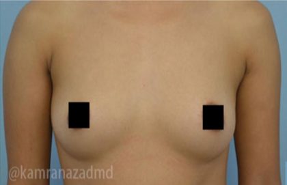 Breast Augmentation Before & After Patient #2141