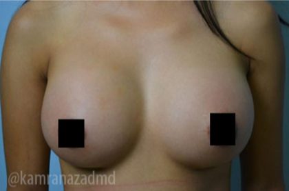 Breast Augmentation Before & After Patient #2141