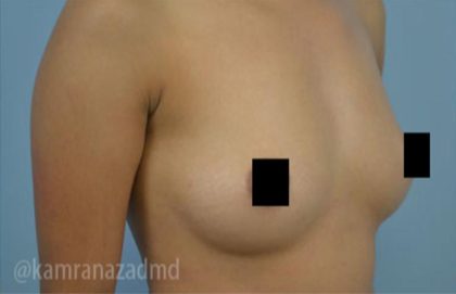 Breast Augmentation Before & After Patient #2141