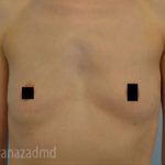 Breast Augmentation Before & After Patient #2142