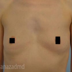 Breast Augmentation Before & After Patient #2142