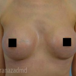 Breast Augmentation Before & After Patient #2142