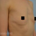 Breast Augmentation Before & After Patient #2142