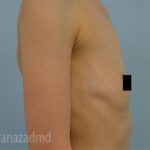 Breast Augmentation Before & After Patient #2142
