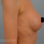 Breast Augmentation Before & After Patient #2142