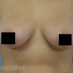 Breast Augmentation Before & After Patient #2143