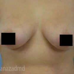Breast Augmentation Before & After Patient #2143
