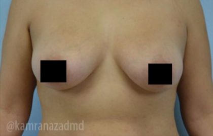 Breast Augmentation Before & After Patient #2143