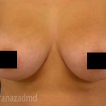 Breast Augmentation Before & After Patient #2143