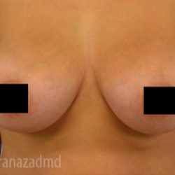 Breast Augmentation Before & After Patient #2143
