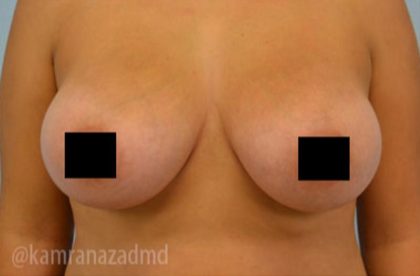 Breast Augmentation Before & After Patient #2143