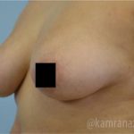 Breast Augmentation Before & After Patient #2143