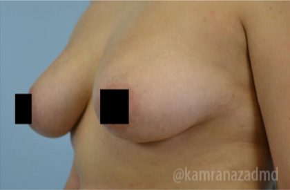 Breast Augmentation Before & After Patient #2143