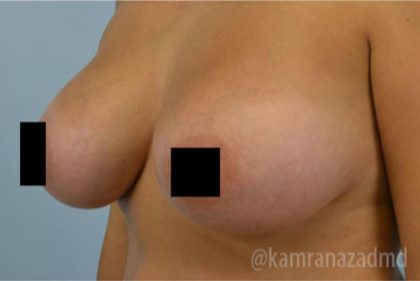 Breast Augmentation Before & After Patient #2143