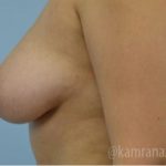 Breast Augmentation Before & After Patient #2143