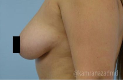 Breast Augmentation Before & After Patient #2143