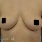 Breast Augmentation Before & After Patient #2144
