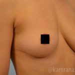 Breast Augmentation Before & After Patient #2144