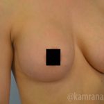 Breast Augmentation Before & After Patient #2144