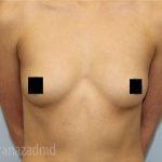 Breast Augmentation Before & After Patient #2145