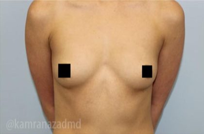 Breast Augmentation Before & After Patient #2145