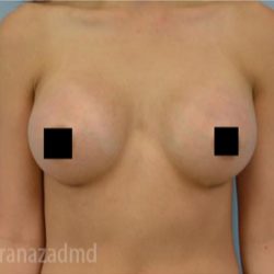 Breast Augmentation Before & After Patient #2145