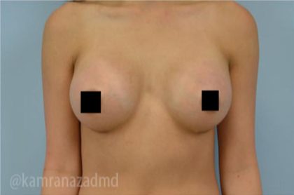 Breast Augmentation Before & After Patient #2145