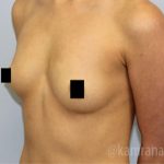 Breast Augmentation Before & After Patient #2145