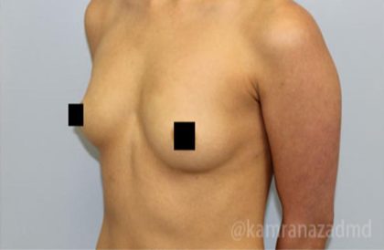 Breast Augmentation Before & After Patient #2145