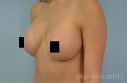 Breast Augmentation Before & After Patient #2145