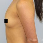 Breast Augmentation Before & After Patient #2145