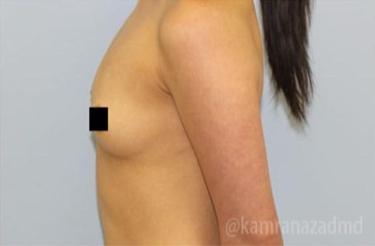 Breast Augmentation Before & After Patient #2145